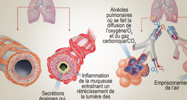 Fin de vie d'insuffisance pulmonaire